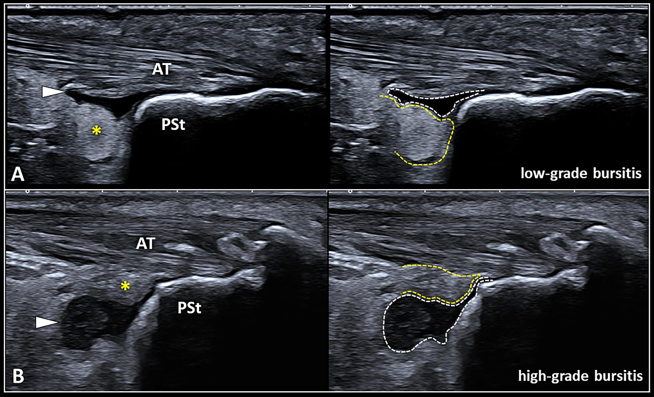 Bursa retrocalcanea 5 Tempo Formacion ecografia.jpg